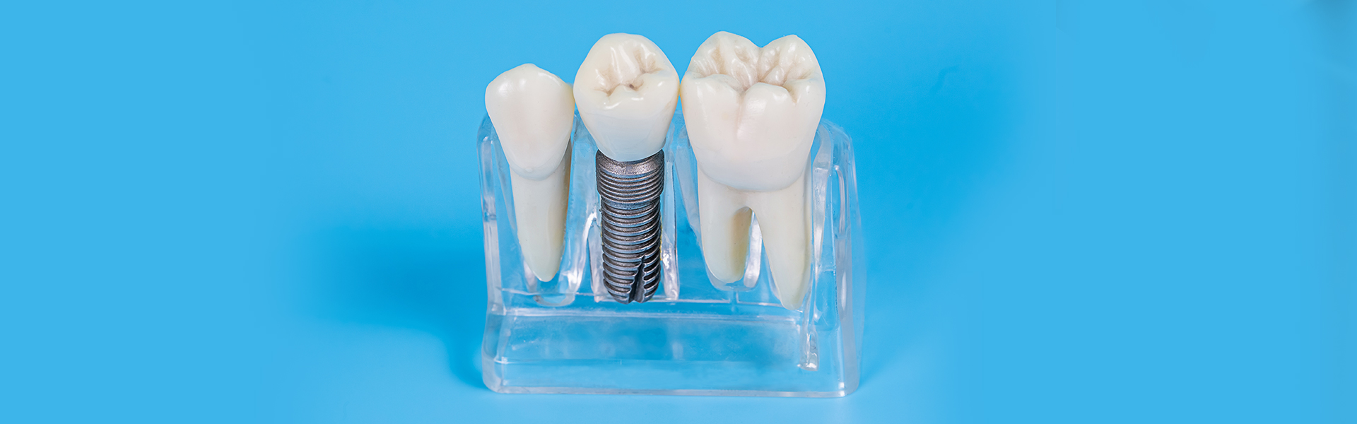 Aftercare for Dental Implants by Dentist in Burlington