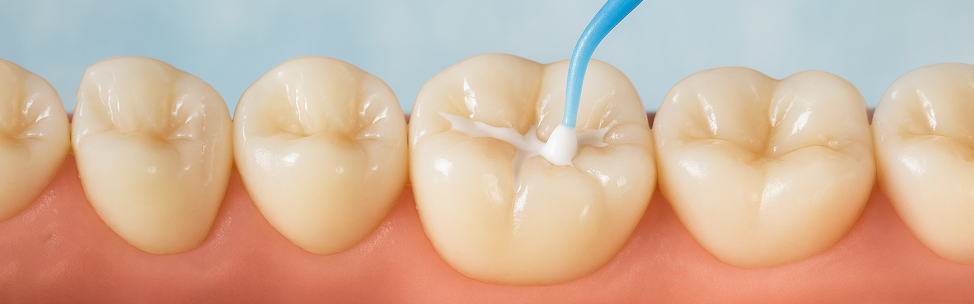 Say Goodbye to Cavities with Dental Sealants