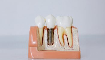 What Are the Key Steps Involved in Getting Dental Implants?