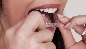 10 Things to Know Before Starting Invisalign Treatment